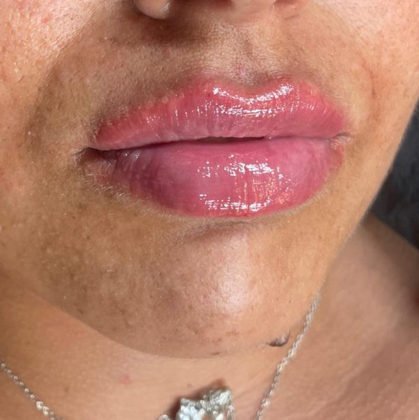 Botulinum Toxin