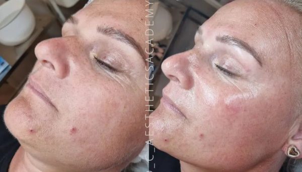 Advanced Facials