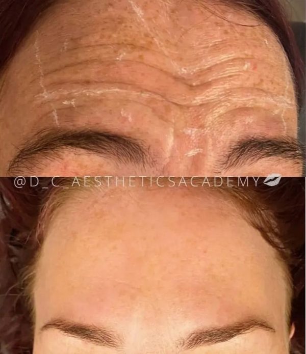 Facial Line Softening